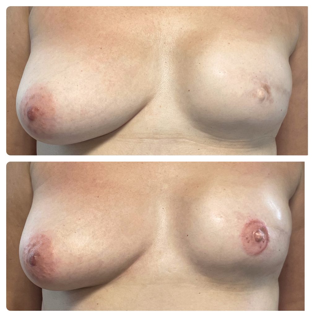 micropigmentación de areola en Madrid resultado natural